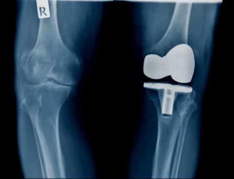 Joint Replacement - Orthopedic and Spine Centers of Wisconsin