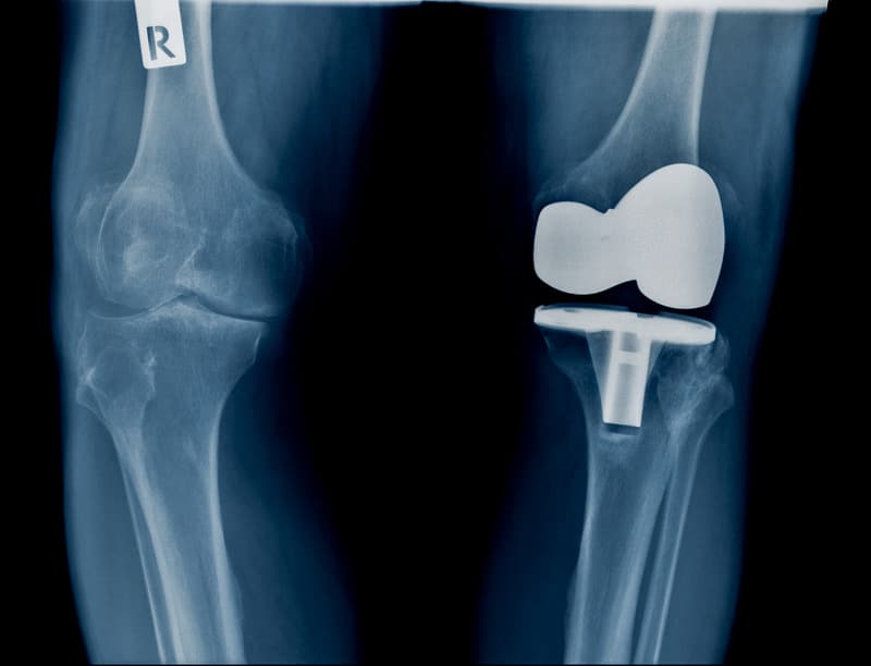 Hight Quality X Ray With Knee Joint Replacement